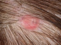 Brooke-Spiegler syndroom