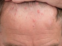 Brooke-Spiegler syndroom