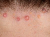 Brooke-Spiegler syndroom