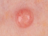 Brooke-Spiegler syndroom