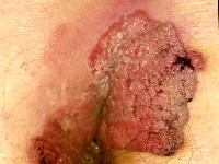 Reuzen condyloma van Buschke en Löwenstein