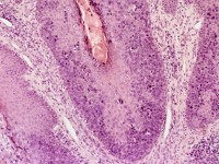 Reuzen condyloma van Buschke en Löwenstein