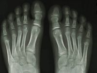 Buschke-Ollendorff syndroom