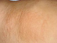 Buschke-Ollendorff syndroom