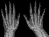 Buschke-Ollendorff syndroom