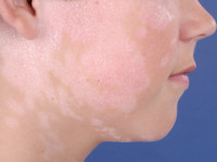 CARD14‑associated papulosquamous eruption (CAPE)