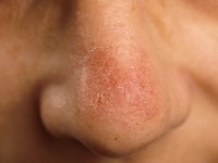 Chronic discoid lupus erythematosus (CDLE)