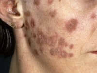 Chronic discoid lupus erythematosus (CDLE)