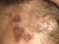 Chronic discoid lupus erythematosus (CDLE)