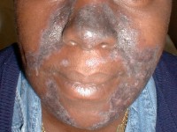 Chronische discoide lupus erythematosus (CDLE)