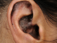 Chronische discoide lupus erythematosus (CDLE)