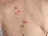 Chronische discoide lupus erythematosus (CDLE)