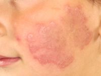 Chronische discoide lupus erythematosus (CDLE)