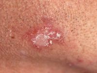 Chronische discoide lupus erythematosus (CDLE)