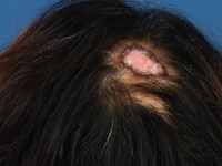 CDLE van het behaarde hoofd