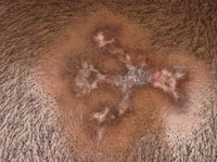 CDLE of the hairy head