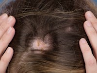 CDLE van het behaarde hoofd