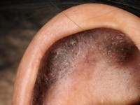 Folliculaire pluggen