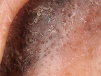 Folliculaire pluggen