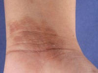 Churg-Strauss syndroom