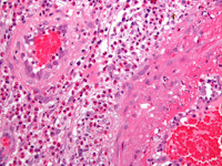 Churg-Strauss syndroom