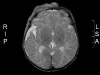 Dandy-Walker malformatie