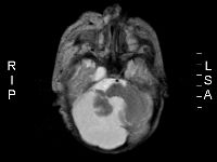 Dandy-Walker malformatie