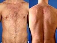 Darier's disease, dyskeratosis follicularis