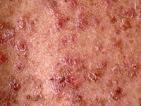 Darier's disease, dyskeratosis follicularis