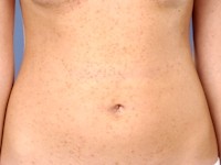 Ziekte van Darier, dyskeratosis follicularis