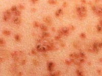 Ziekte van Darier, dyskeratosis follicularis