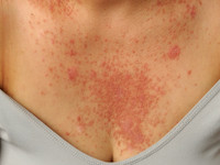 Darier's disease, dyskeratosis follicularis