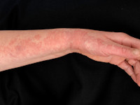 Ziekte van Darier, dyskeratosis follicularis