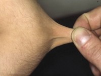 Ehlers-Danlos syndroom