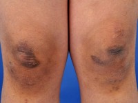 Ehlers-Danlos syndroom