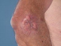 Erdheim-Chester disease