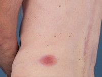 Erdheim-Chester disease