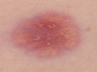 Erdheim-Chester disease