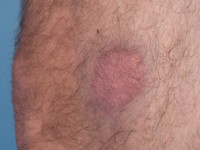 Erdheim-Chester disease