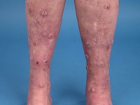 Ferguson-Smith disease (multiple self-healing squamous epithelioma)