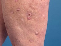 Ferguson-Smith disease (multiple self-healing squamous epithelioma)