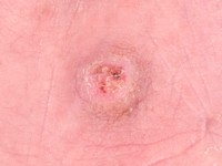 Ferguson-Smith disease (multiple self-healing squamous epithelioma)