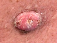 Ferguson-Smith disease (multiple self-healing squamous epithelioma)