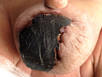 Gangreen van Fournier