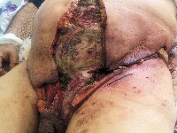 Gangreen van Fournier