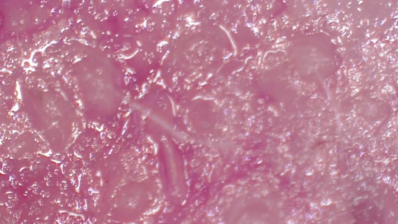 Demodexmijt wandelend over de huid (video)