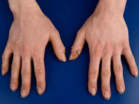 Therapieresistente verrucae vulgares bij GATA2 deficiëntie