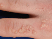 Therapieresistente verrucae vulgares bij GATA2 deficiëntie