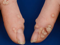 Therapieresistente verrucae vulgares bij GATA2 deficiëntie