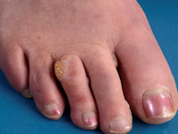 Therapieresistente verrucae vulgares bij GATA2 deficiëntie